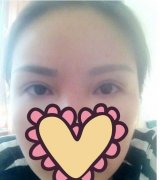 雙眼皮修復手術方法