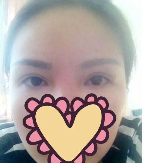 雙眼皮修復(fù)手術(shù)方法