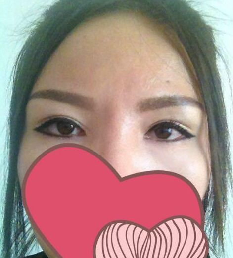 雙眼皮修復(fù)手術(shù)方法