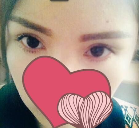 雙眼皮修復(fù)手術(shù)方法