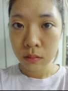 雙眼皮手術修復方法