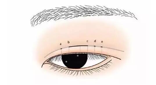 雙眼皮手術,幾天,可以上班,有什么,注意事項