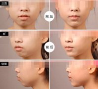 假體墊下巴能保持多久