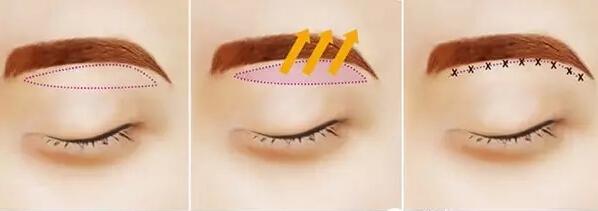 切眉手術前后對比照片