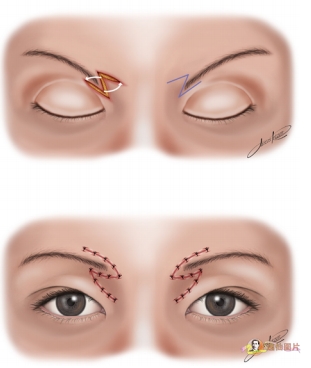 切眉手術前后對比照片