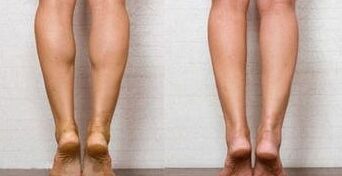 注射瘦臉注射瘦腿能維持多久