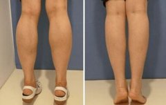 注射注射瘦臉注射瘦腿幾天起