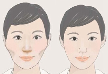 廣州曙光醫(yī)學(xué)美容醫(yī)院,顴骨手術(shù),怎么樣,多少錢