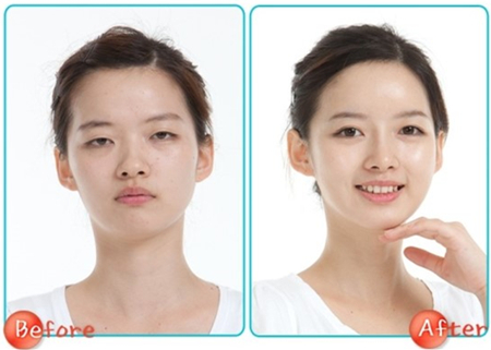 雙眼皮失敗,六種表現(xiàn),修復(fù)方法