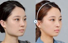 磨骨瘦臉手術(shù)的費(fèi)用貴嗎