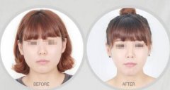 長曲線截骨術(shù)哪些人可以做 長曲線截骨術(shù)哪些人可以做