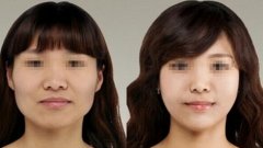 下頜骨整形會(huì)留疤痕嗎