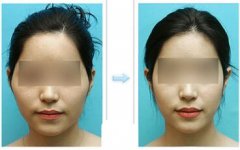 顴骨整形需多久恢復(fù) 顴骨整形需多久恢復(fù)