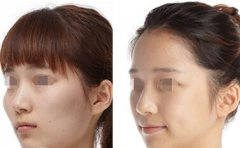 做顴骨整形術(shù)要注意什么 做顴骨整形術(shù)要注意什么