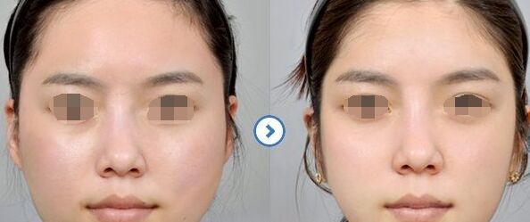 顴骨整形手術(shù)會(huì)留下疤痕嗎