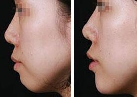 膨體墊下巴會被吸收嗎