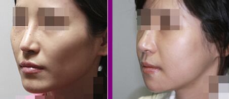 哪些人適合做顴骨整形手術(shù)