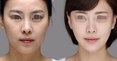 顴骨縮小后臉會(huì)變小嗎 顴骨縮小后臉會(huì)變小嗎