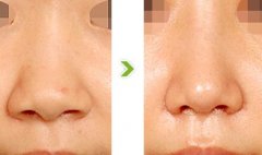 鼻翼縮小哪些人適合做