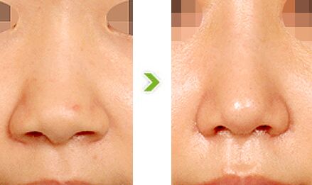 鼻翼縮小哪些人適合做