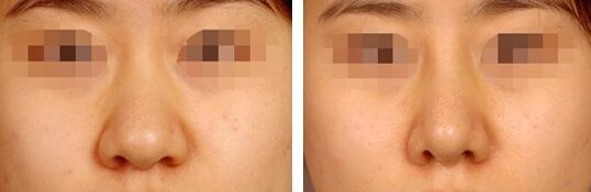鼻翼縮小有哪幾種方法