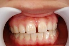 補牙縫一般需要多少錢