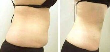 腹部吸脂減肥的價(jià)格多少