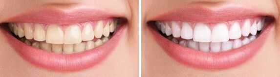 冷光美白牙齒去黃黑牙的成好嗎