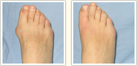 長春,大腳骨,矯正,多少錢