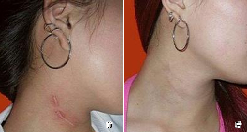 佛山,疤痕,修復,大概,多少錢