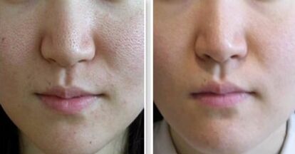 激光可以緩解毛孔粗大嗎