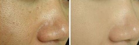 激光收縮毛孔多少錢