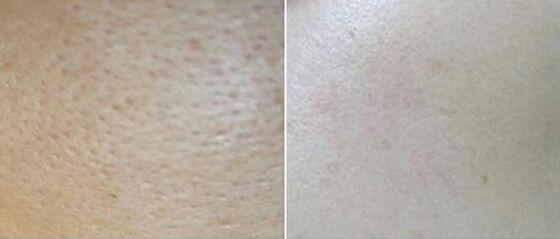 激光收縮毛孔后多久能見