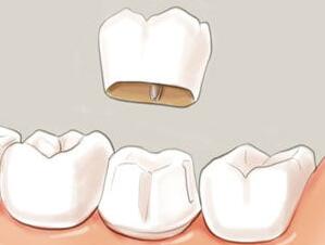 天津,華美,做烤瓷牙,大概,多少錢