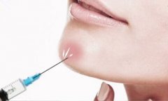 玻尿酸豐下巴能維持多久