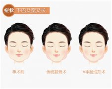 下頜角整形后多久能化妝 術(shù)后注意事項(xiàng) 下頜角整形后多久能化妝 術(shù)后注意事項(xiàng)