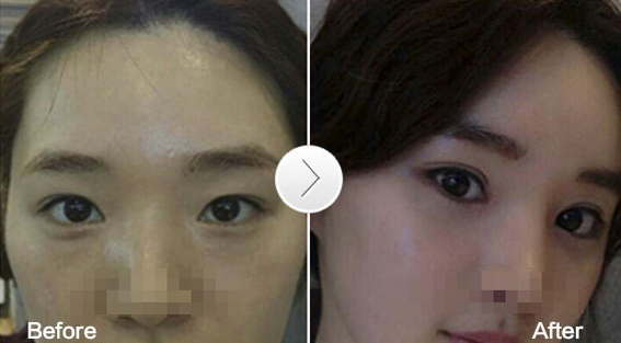 雙眼皮,割的太寬,該怎么修復(fù)呢