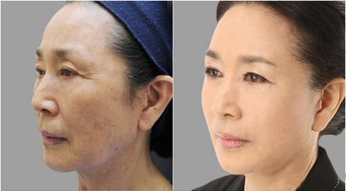 拉皮除皺手術(shù)讓我年輕20歲