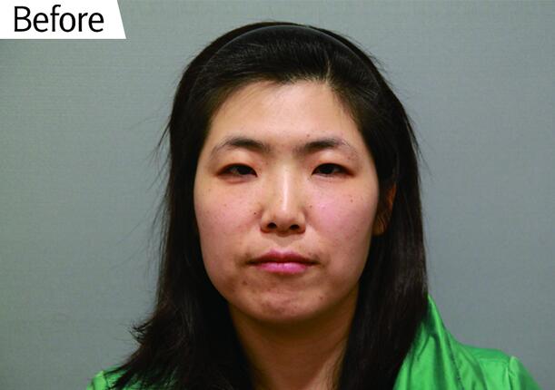 電波l皮除皺讓我彈走小皺紋 果真的很不錯(cuò)