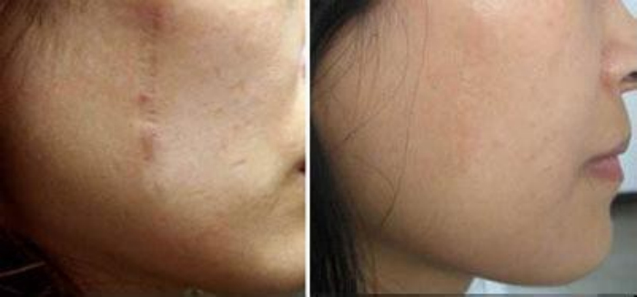 上海,植皮,手術(shù),前后,對(duì)比,果,圖片,過程