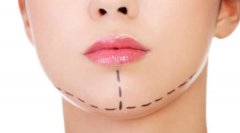 自體脂肪豐下巴的果及注意事項(xiàng)