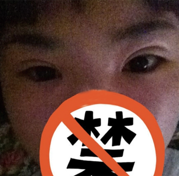 雙眼皮修復(fù)成功辣  再也不用擔(dān)心異樣的眼光辣