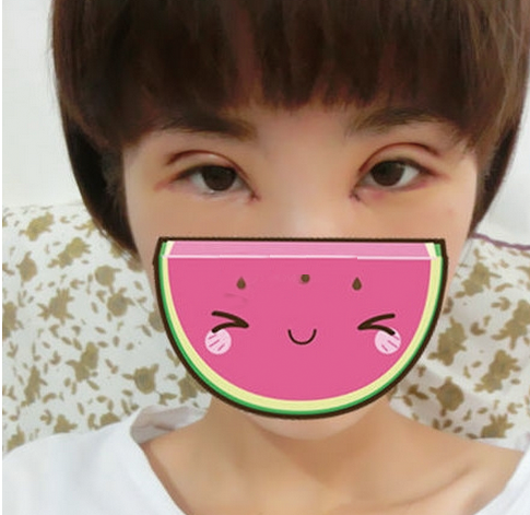 雙眼皮修復(fù)成功辣  再也不用擔(dān)心異樣的眼光辣