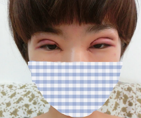 雙眼皮修復(fù)成功辣  再也不用擔(dān)心異樣的眼光辣