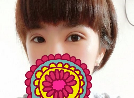 雙眼皮修復(fù)成功辣  再也不用擔(dān)心異樣的眼光辣