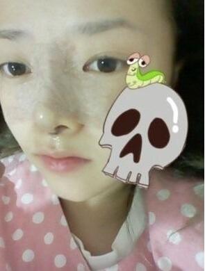 硅膠隆鼻手術(shù)圓了我高鼻梁的夢(mèng)