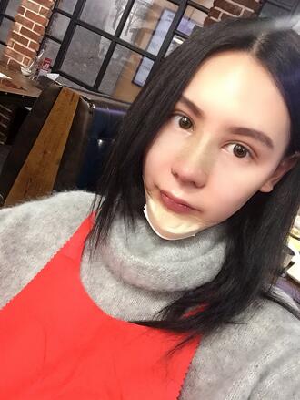成都天使之翼做隆鼻整形改變了我的塌鼻子 果真的很不錯(cuò)