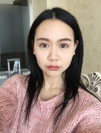 成都天使之翼做隆鼻整形改變了我的塌鼻子 果真的很不錯(cuò)