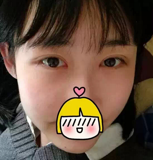 雙眼皮修復(fù)需要慎重 可是我幸運(yùn)的修復(fù)好了雙眼皮