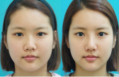 鼻翼收縮術(shù)大概多少錢(qián) 2017價(jià)格表及前后對(duì)比圖